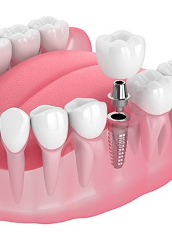 Illustration of a single dental implant