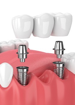 Illustration of implant bridge