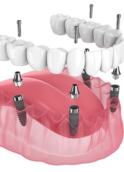 Illustration of an implant denture