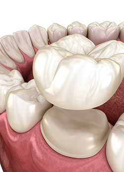 Illustration of dental crown being attached to tooth