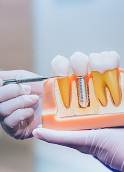 A glove-wearing dentist holding an enlarged dental implant model