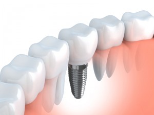 An Enterprise dental implant from Tyler B.Schaffeld DDS looks and feels like a natural tooth. Learn about this dental wonder and how to care for it.