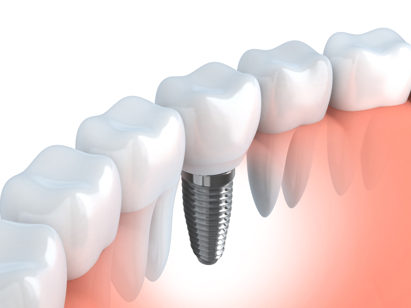 How to care for an Enterprise dental implant Tyler B. Schaffeld DMD Blog