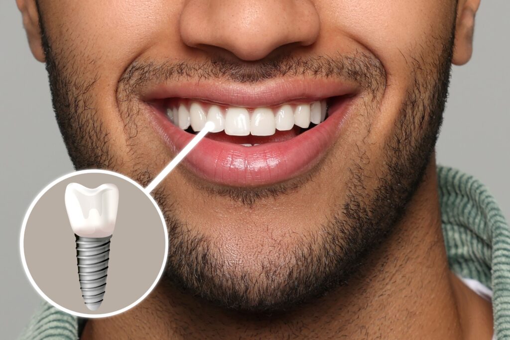 Nose-to-neck view of man smiling with a front tooth indicated as implant