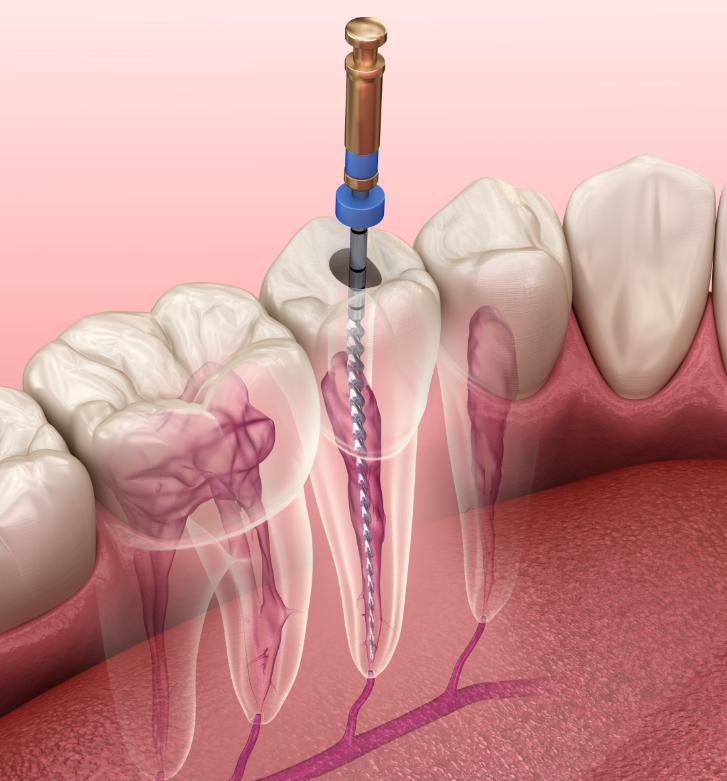 Root canal illustration