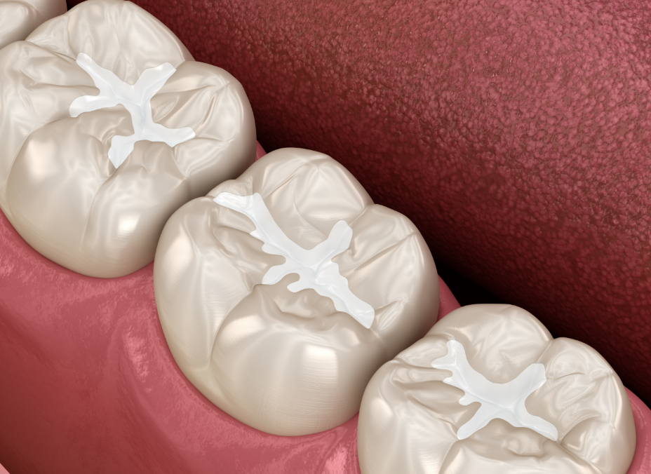 3D image of amalgam fillings